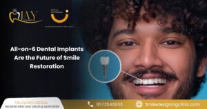Why All-on-6 Dental Implants Are the Future of Smile Restoration