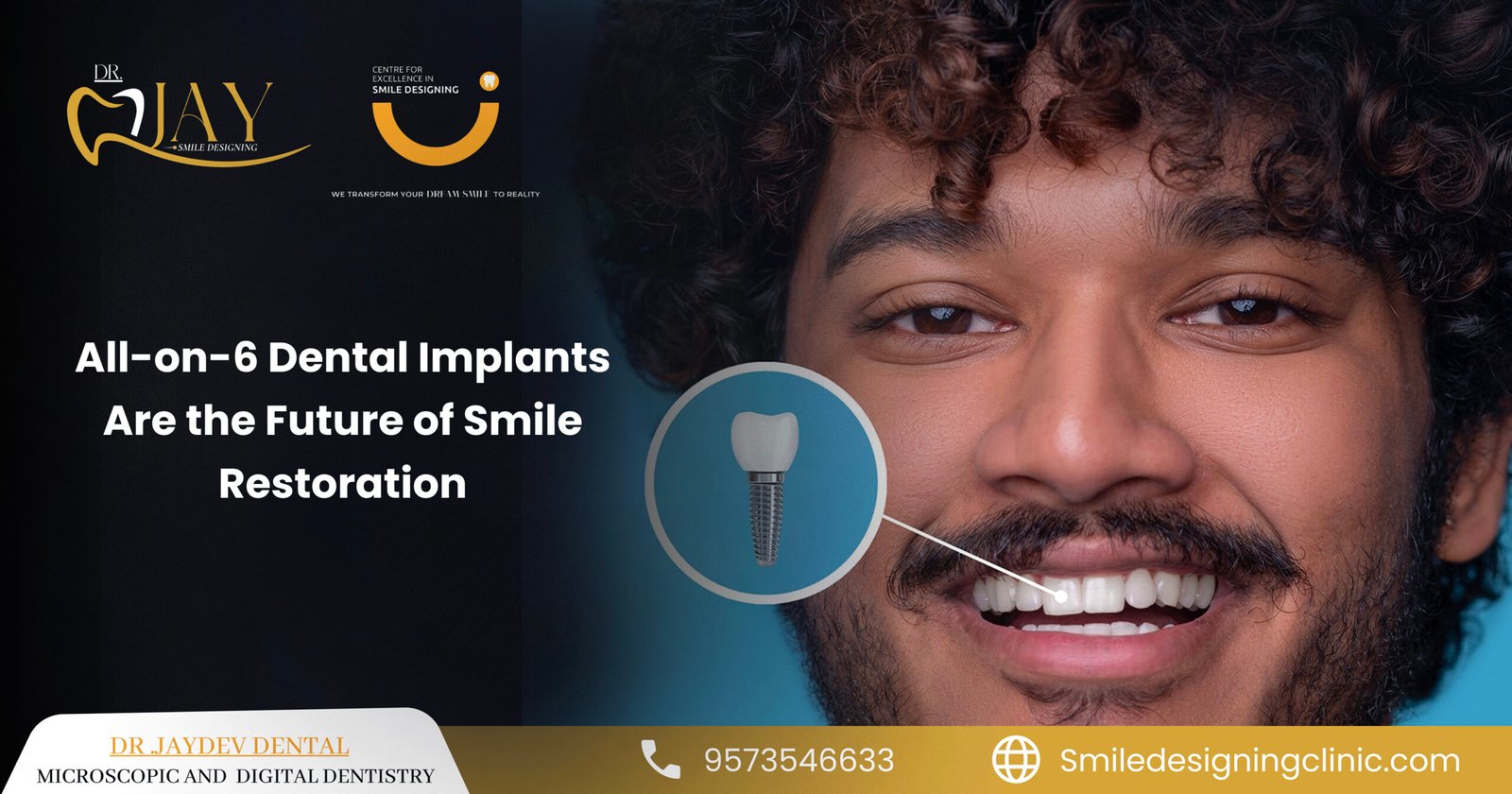 all on 6 dental implants