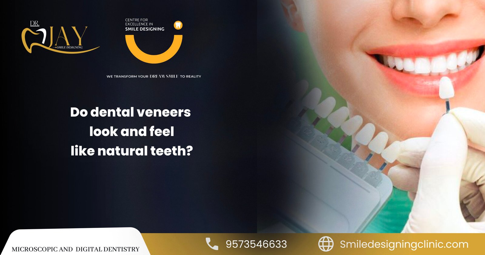 Dental Veneers